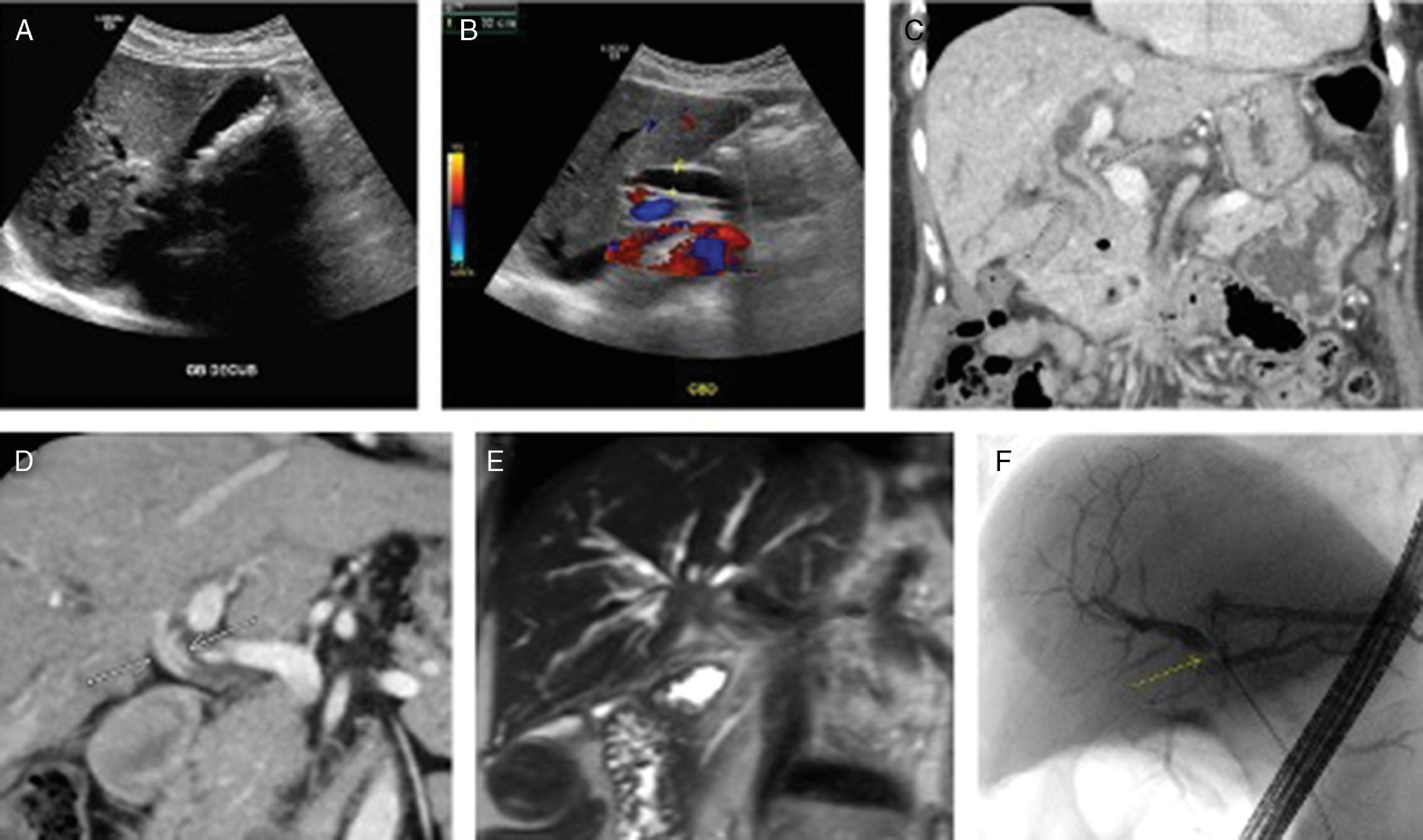 FIG. 1, Imaging findings with cholangitis. (A) Cholelithiasis on ultrasound. (B) Common bile duct dilation on ultrasound. (C) Extrahepatic bile duct dilation on abdominal CT. Common hepatic duct stricture from cholangiocarcinoma seen on abdominal CT (D), MRCP (E), and ERCP (F).