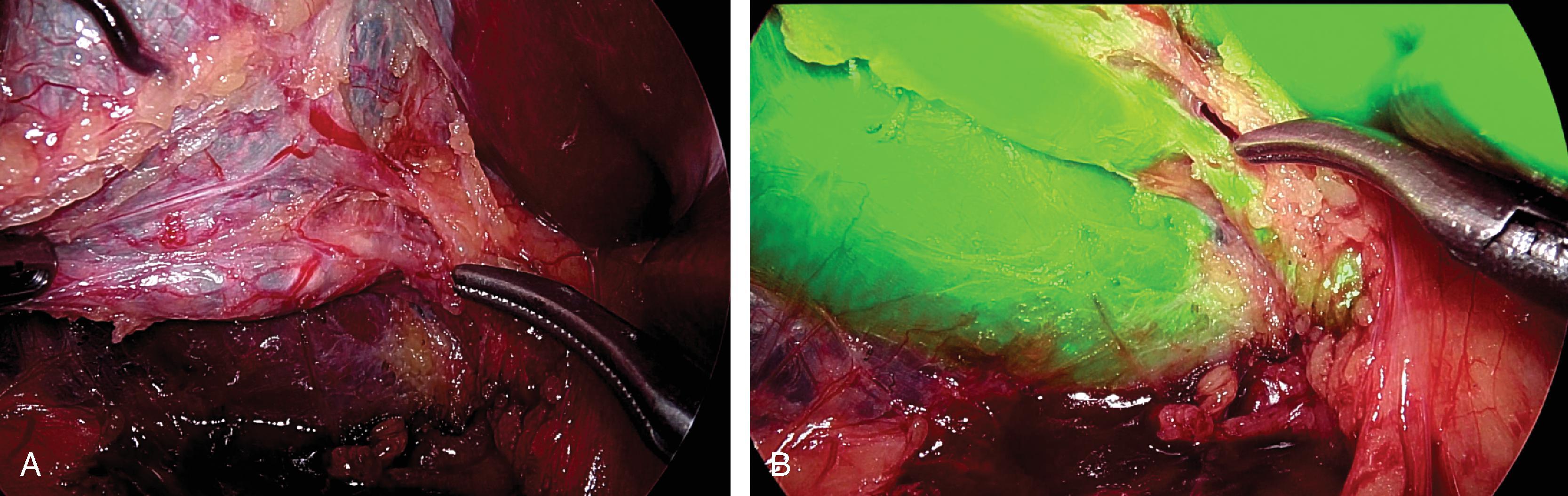 FIG. 1, (A) Bright light/traditional laparoscopic view; instrument points to cystic duct. (B) Fluorescence cholangiography with “overlay” mode for the same patient as in (A) ; instrument points to cystic duct with cystic/common duct junction noted inferior to instrument.