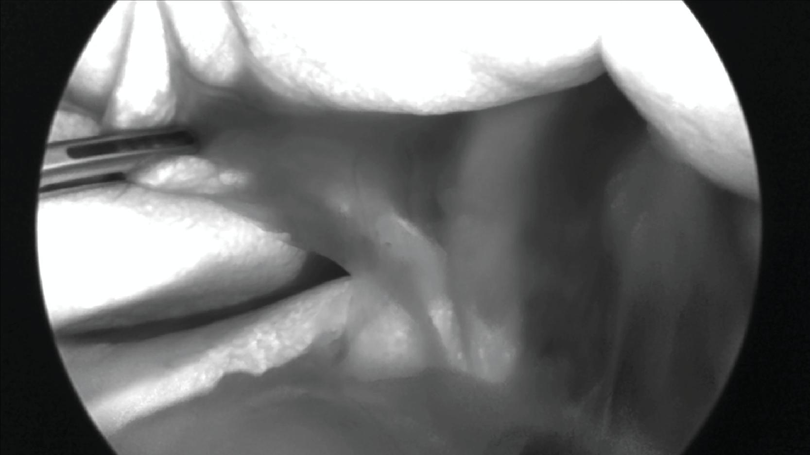 FIG. 2, Fluorescence cholangiography with grayscale mode. Grasper is retracting infundibulum while cystic duct and common bile duct are visible before peritoneal dissection.