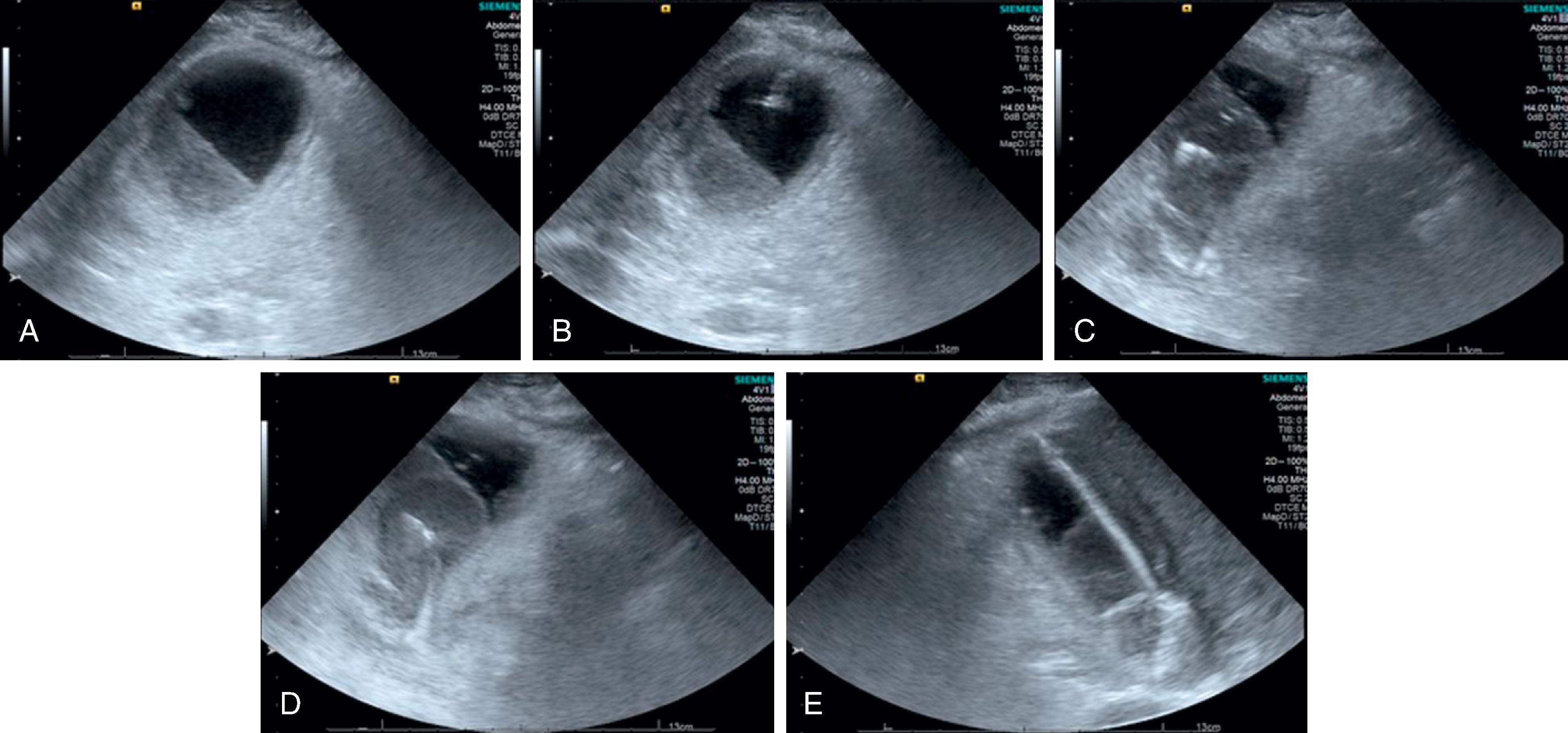 FIG. 3, Ultrasound placement of a cholecystostomy tube. (A) Gallbladder is visualized. (B, C) Gallbladder is accessed with a Yeah needle. (D, E) Pigtail catheter is placed into the gallbladder lumen.