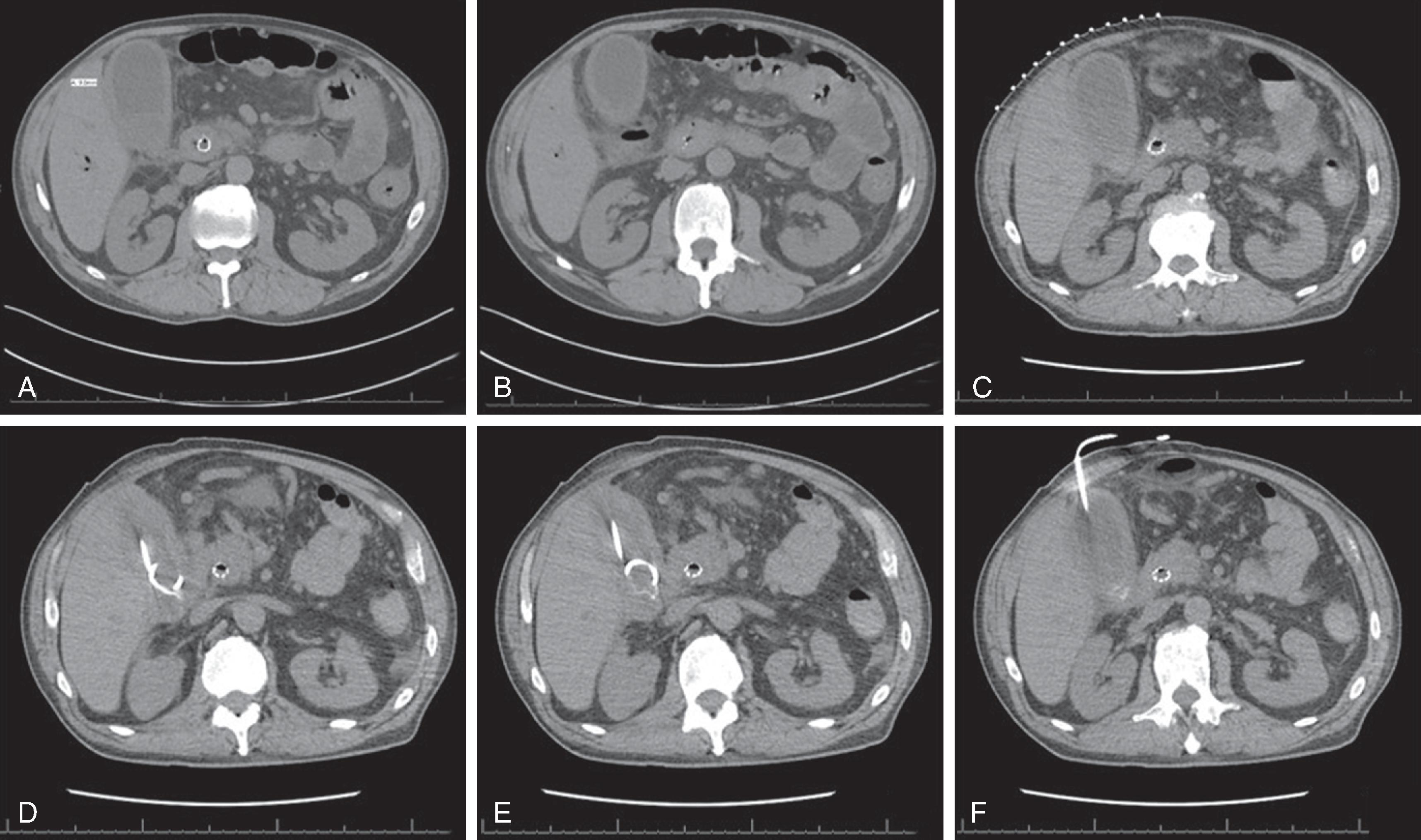 FIG. 4, Computed tomography placement of a cholecystostomy tube. (A, B) Gallbladder is visualized. (C) Computed tomography markers are placed on the abdominal skin on the right upper quadrant to help with guidance. (D–F) Verification of pigtail catheter placement in the gallbladder lumen.