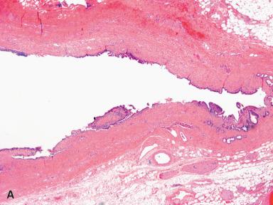 Figure 21.12, A, Choledochal cyst with an overall intact epithelial lining and minimal chronic inflammation. B, In contrast, this section from another case shows a completely denuded epithelial lining with underlying acute and chronic inflammation.