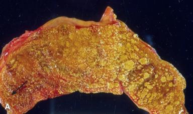 Figure 21.13, A, This gross photograph of an opened gallbladder shows the linear yellow streaks characteristic of cholesterolosis (arrow) , as well as larger polypoid projections indicative of cholesterol polyps. B and C, Histologically, cholesterolosis features foamy, lipid-filled macrophages within the lamina propria. D, When one or more of the deposits grows larger and protrudes into the lumen, it is referred to as a cholesterol polyp.