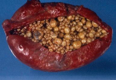 Figure 21.14, Numerous mixed cholesterol gallstones in a background of acute and chronic cholecystitis.