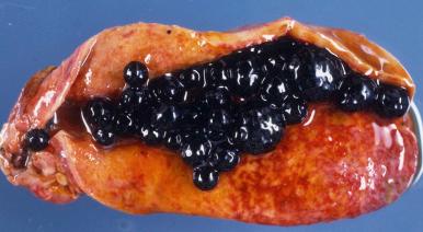 Figure 21.15, Dilated gallbladder containing multiple black (calcium bilirubinate) gallstones.