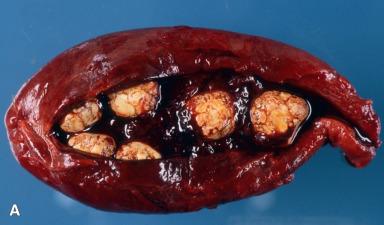 Figure 21.17, Acute Cholecystitis.