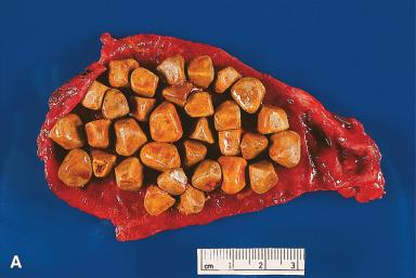 Figure 21.18, A, Gallbladder containing numerous mixed cholesterol stones. The wall is mildly thickened due to chronic cholecystitis. B, The wall of this gallbladder with chronic cholecystitis is markedly thickened, and it contains numerous bilirubin gallstones. C, This section of a case of chronic cholecystitis shows a markedly thickened wall with muscle hypertrophy and numerous Rokitansky–Aschoff sinuses, some of which contain inspissated thick bile. D, Chronic cholecystitis featuring a thickened fibrotic wall and mononuclear inflammation within the mucosa. E, Intestinal metaplasia is common in chronic cholecystitis; this case shows areas of intestinal metaplasia as well as epithelial dysplasia. F, Florid pyloric metaplasia in a case of chronic cholecystitis.