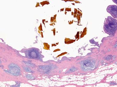 Figure 21.19, This case of follicular cholecystitis shows lymphoid follicles, many with germinal centers, throughout the wall of the gallbladder.