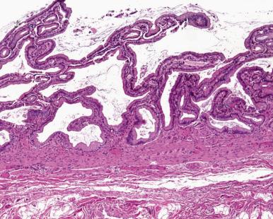 Figure 21.2, The gallbladder wall contains three layers: mucosa, muscularis propria, and serosa on the free surface. There is no muscularis mucosae or submucosa, thus the lamina propria abuts directly onto the muscularis propria. The mucosa is composed of variably sized branching folds consisting of a core of lamina propria lined by a single layer of columnar epithelium.