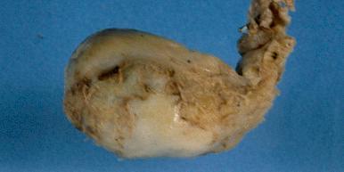 Figure 21.21, This gallbladder wall is almost completely replaced by calcification, known as “porcelain” gallbladder.