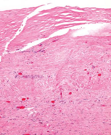 Figure 21.22, Hyalinizing cholecystitis features replacement of the gallbladder wall by dense hyaline fibrosis, with minimal inflammation and denuding of epithelium.