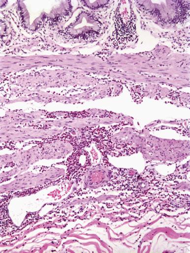 Figure 21.23, “Pure” eosinophilic cholecystitis contains an inflammatory infiltrate composed almost entirely of eosinophils.