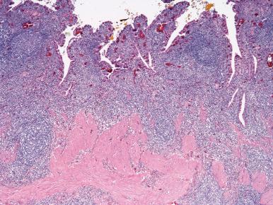 Figure 21.24, This case of diffuse lymphoplasmacytic cholecystitis contained numerous IgG4-positive plasma cells on immunostaining.