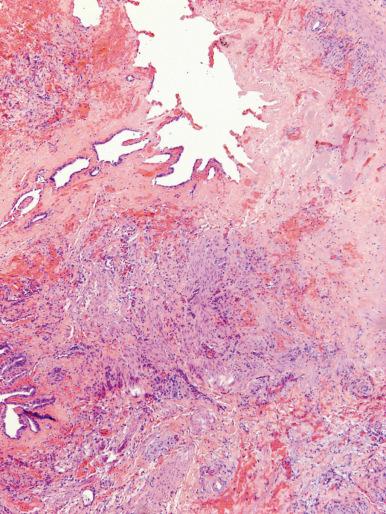 Figure 21.25, Hemorrhagic necrosis and mucosal ulceration in a case of gallbladder ischemia that occurred during liver transplant surgery.