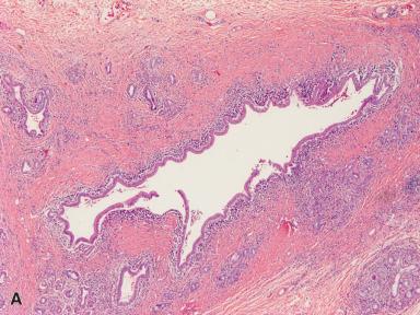 Figure 21.27, A, Common hepatic duct in primary sclerosing cholangitis shows a lymphoplasmacytic infiltrate underlying epithelium that is primarily intact. B, A more advanced case shows dense lymphoplasmacytic inflammation with fibrosis, epithelial disarray, and compromise of the duct lumen.