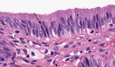 Figure 21.3, Gallbladder epithelial cells have eosinophilic cytoplasm with basally located nuclei. Smaller, darkly staining columnar cells known as penciloid cells are interspersed within the epithelium (arrow) , as well as basal cells that are often inconspicuous (arrowhead).