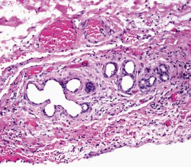 Figure 21.4, The ducts of Luschka are normal small accessory bile ducts typically located in the perimuscular connective tissue on the hepatic surface of the gallbladder. There is a distinctive ring of surrounding connective tissue, which helps distinguish them from carcinoma, particularly on frozen section evaluation.