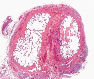 Figure 21.7, Cross section through a congenitally duplicated gallbladder showing duplication of all layers of the gallbladder wall.