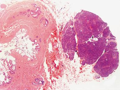 Figure 21.8, Island of heterotopic pancreas adjacent to gallbladder.
