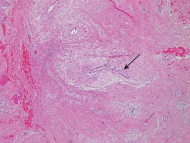 Figure 21.9, This section of the porta hepatis in an infant with biliary atresia shows extensive fibrosis and inflammation and severely damaged, atrophic biliary epithelium with a nearly obliterated lumen (arrow) .