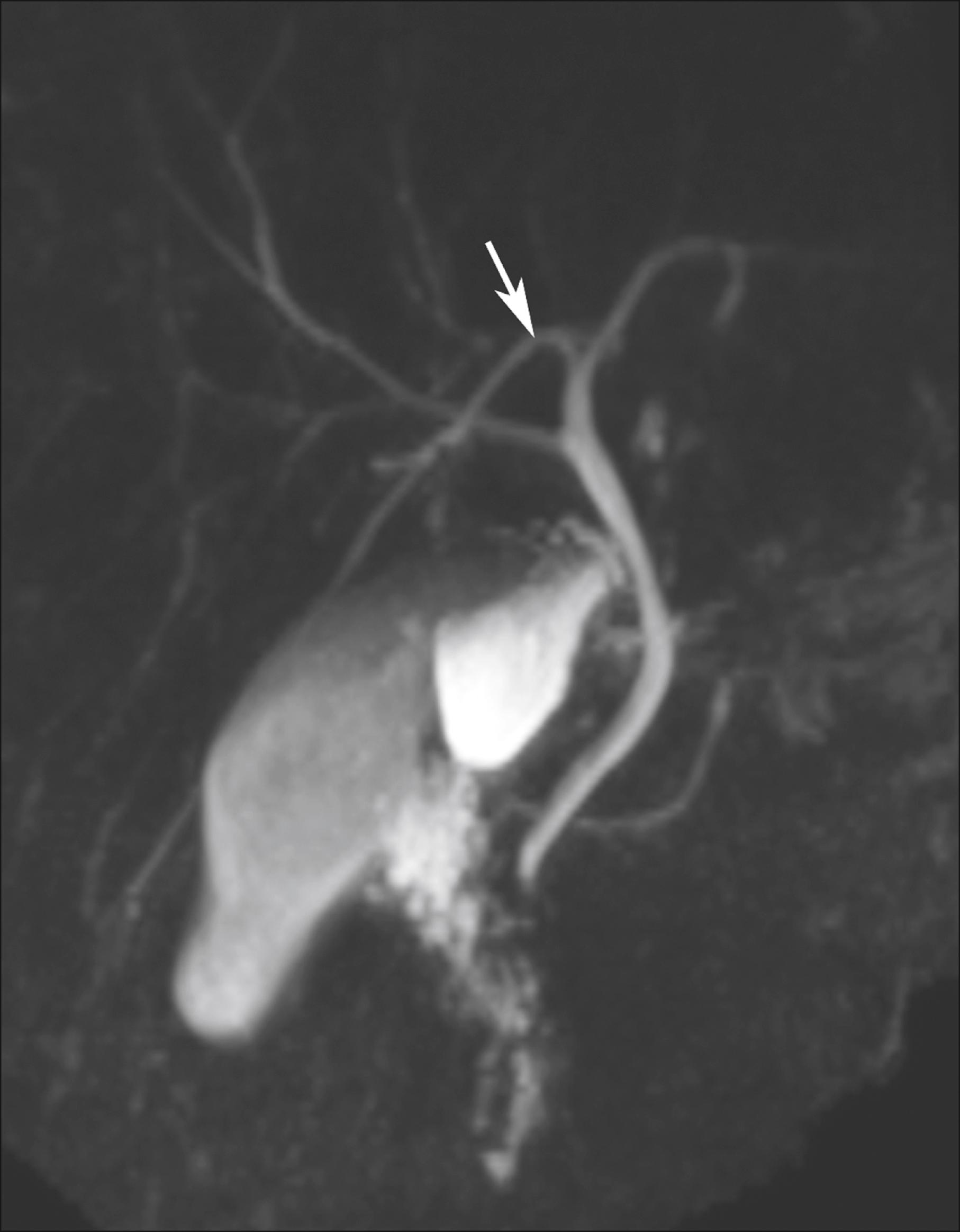 Fig. 67.6, Magnetic resonance cholangiopancreatogram showing the right posterior sectoral duct (arrow) draining into the left hepatic duct (type 3 intrahepatic duct drainage pattern).