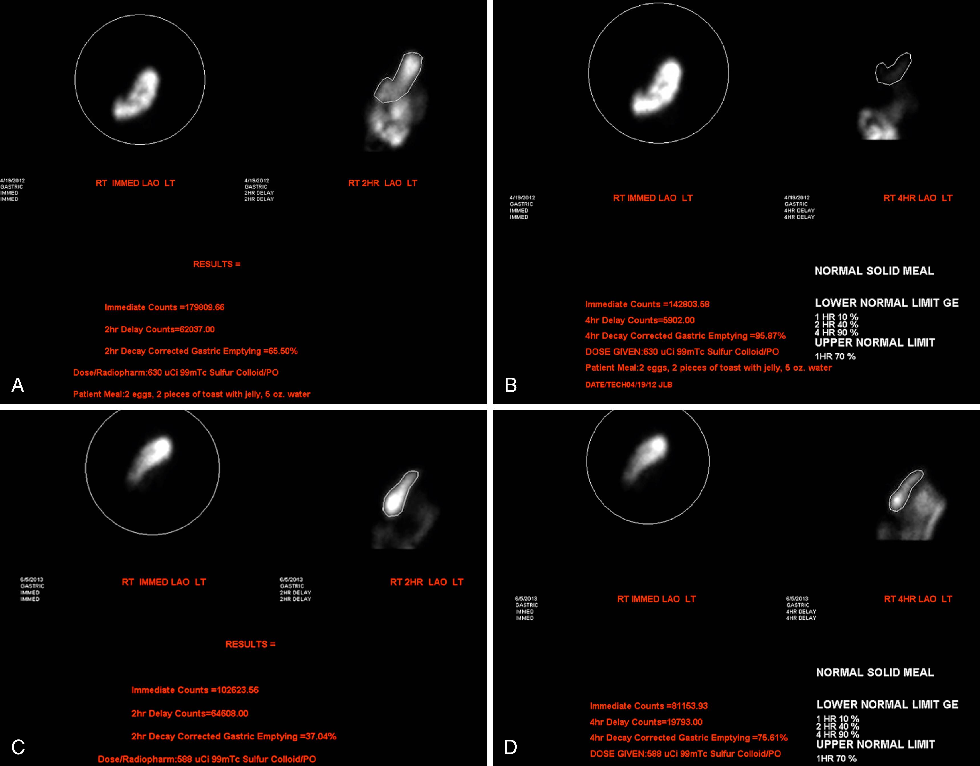 Fig 28.2, Gastric emptying scintigraphy demonstrating normal solid gastric emptying at (A) 2 hours and (B) 4 hours and delayed solid gastric emptying at (C) 2 hours and (D) 4 hours.