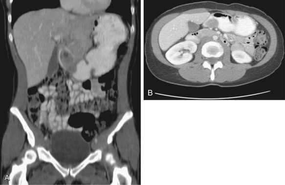 Figure 22-1, A, Coronal computed tomography (CT) reconstructed image after intravenous and oral contrast agent administration demonstrates a markedly distended stomach. B, Axial CT image shows a mass in the distal stomach and antrum. Biopsy of this lesion demonstrated Brunner's gland hyperplasia to be the cause of the gastric outlet obstruction.