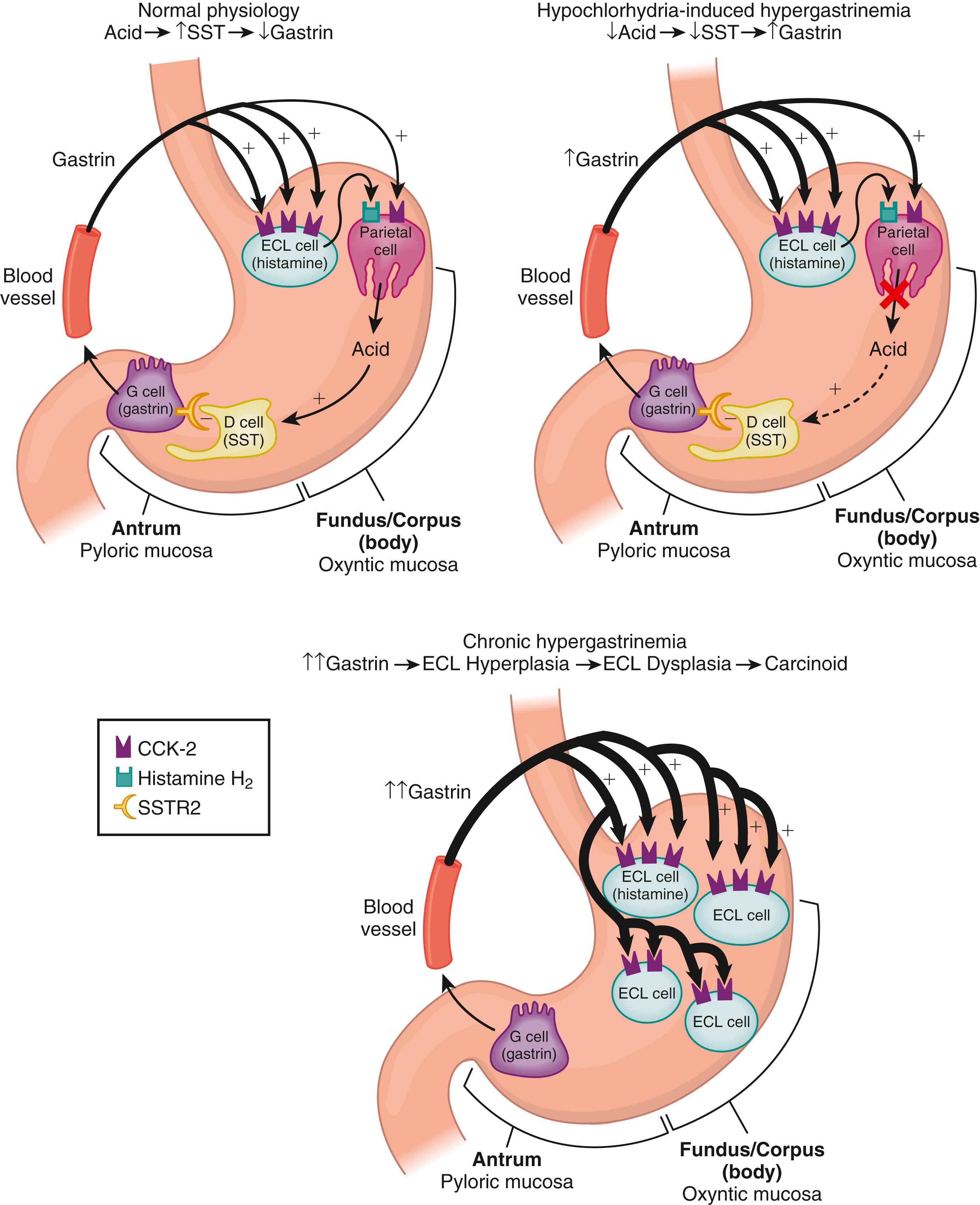 Fig. 51.11, Model illustrating the function and mechanism of gastrin as a secretagogue and trophic hormone in the stomach. Left Panel (Normal Secretory Physiology) : Gastrin, secreted into the local circulation by G cells of the gastric antrum (pyloric mucosa), is the main hormonal stimulant for acid secretion. Acting via CCK-2 receptors, gastrin stimulates the parietal directly and, more importantly, indirectly by releasing histamine from ECL cells. Histamine diffuses to neighboring parietal cells (paracrine pathway) where it binds to histamine H 2 -receptors coupled to generation of cyclic adenosine monophosphate and subsequent activation of the acid proton pump, H + /K + -ATPase. Somatostatin (SST) , secreted by D cells in the antrum, binds to SST2 receptors on G cells and exerts a tonic inhibitory paracrine restraint on gastrin secretion. During the interdigestive state, a local feedback pathway is activated whereby unbuffered luminal acid (acting via release of CGRP from sensory neurons [see Fig. 51.10 ]) stimulates somatostatin and, thus, inhibits gastrin secretion, maintaining acid secretion at economically low levels. Middle Panel (Hypochlorhydria-induced Hypergastrinemia) : When acid secretion is suppressed (e.g., by potent antisecretory medications or gastric oxyntic atrophy), there is lesser stimulation of somatostatin secretion with a reciprocal increase in gastrin secretion; patients develop hypergastrinemia. Right Panel (Chronic Hypergastrinemia) : As gastrin is also a trophic hormone, especially to the oxyntic mucosa, chronic hypergastrinemia, acting via CCK-2 receptors, induces hyperplasia of ECL cells. Increased number of histamine-secreting ECL cells is responsible for rebound gastric acid secretion observed after abrupt withdrawal of PPIs. In susceptible individuals, chronic hypergastrinemia-induced ECL hyperplasia may progress to dysplasia and, eventually, carcinoid tumor.