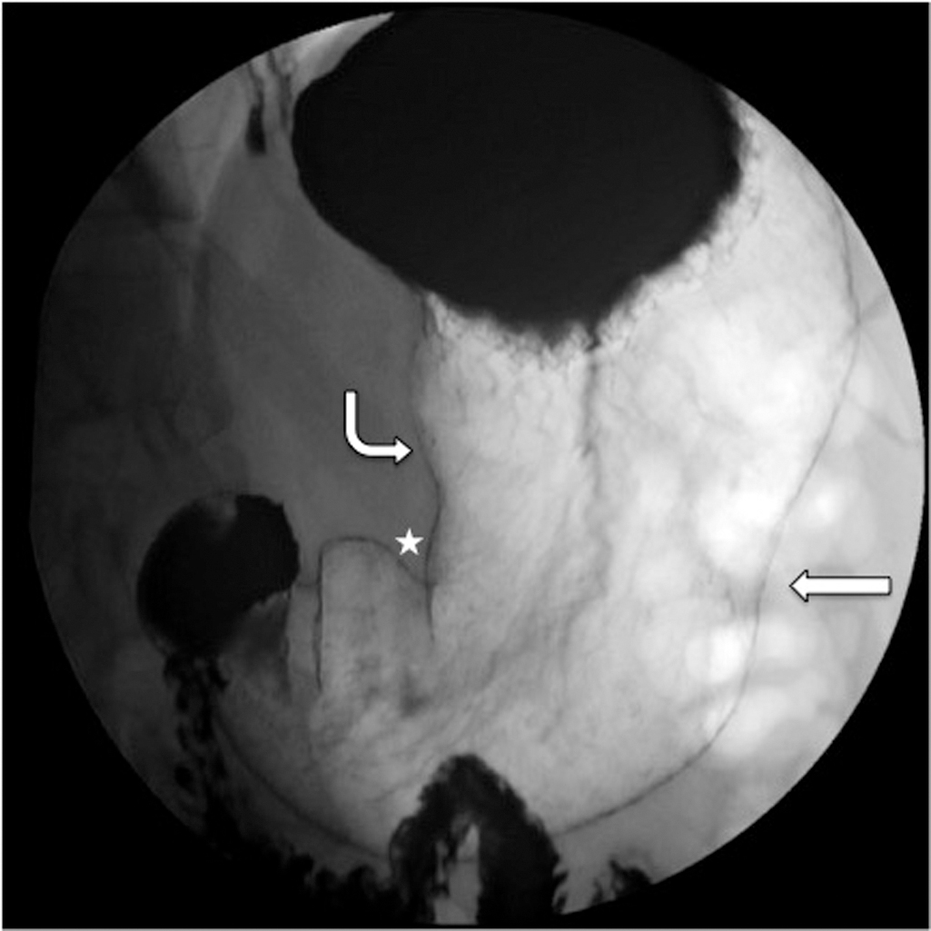 Fig. 3.2, Anterior-posterior view of the stomach demonstrating the greater ( arrow ) and lesser ( curved arrow ) curvatures. The incisura angularis is seen along the lesser curvature ( asterisk ).