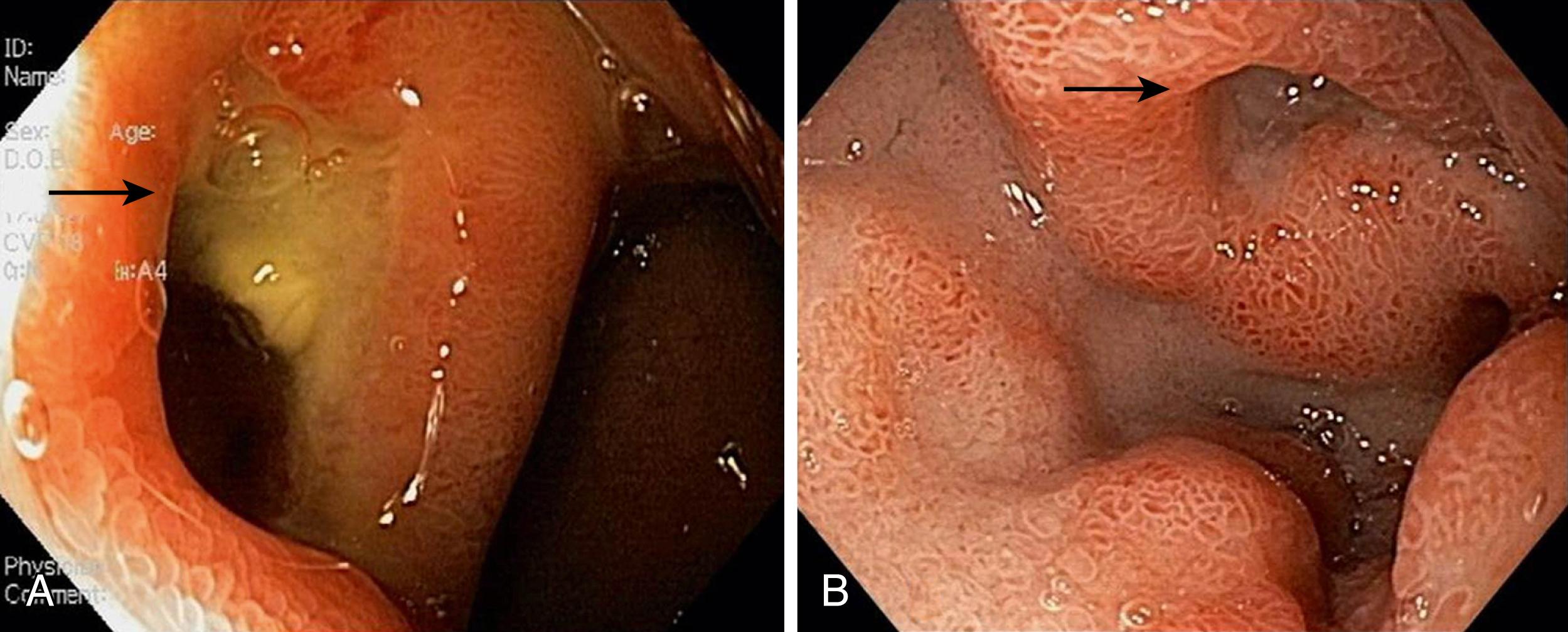 Fig. 26.1, Cratering Duodenal Bulb Ulcers.