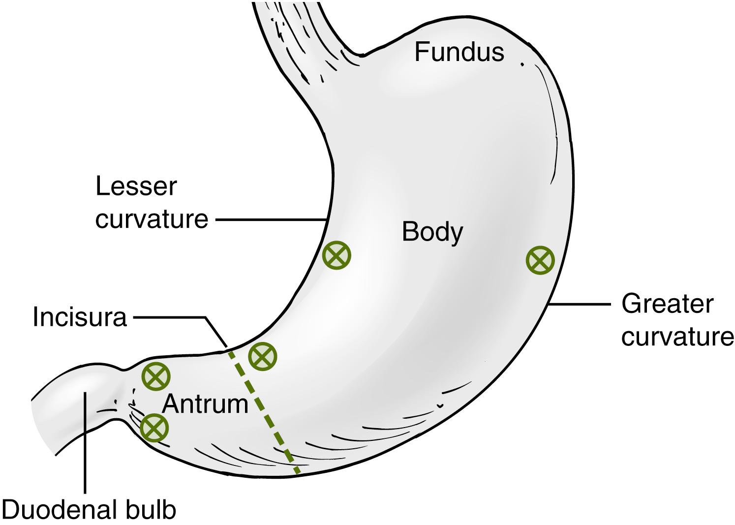 Fig. 26.2, Biopsy sites recommended by the Sydney system for classification of gastritis. 37 Biopsy sites are indicated by the circled “X” and include the following: one biopsy each from the greater and lesser curvature of the antrum, both 2 to 3 cm from the pylorus; one biopsy from the lesser curvature of the body, approximately 4 cm from the incisura; one biopsy from the greater curvature, approximately 8 cm from the cardia; and one biopsy from the incisura.