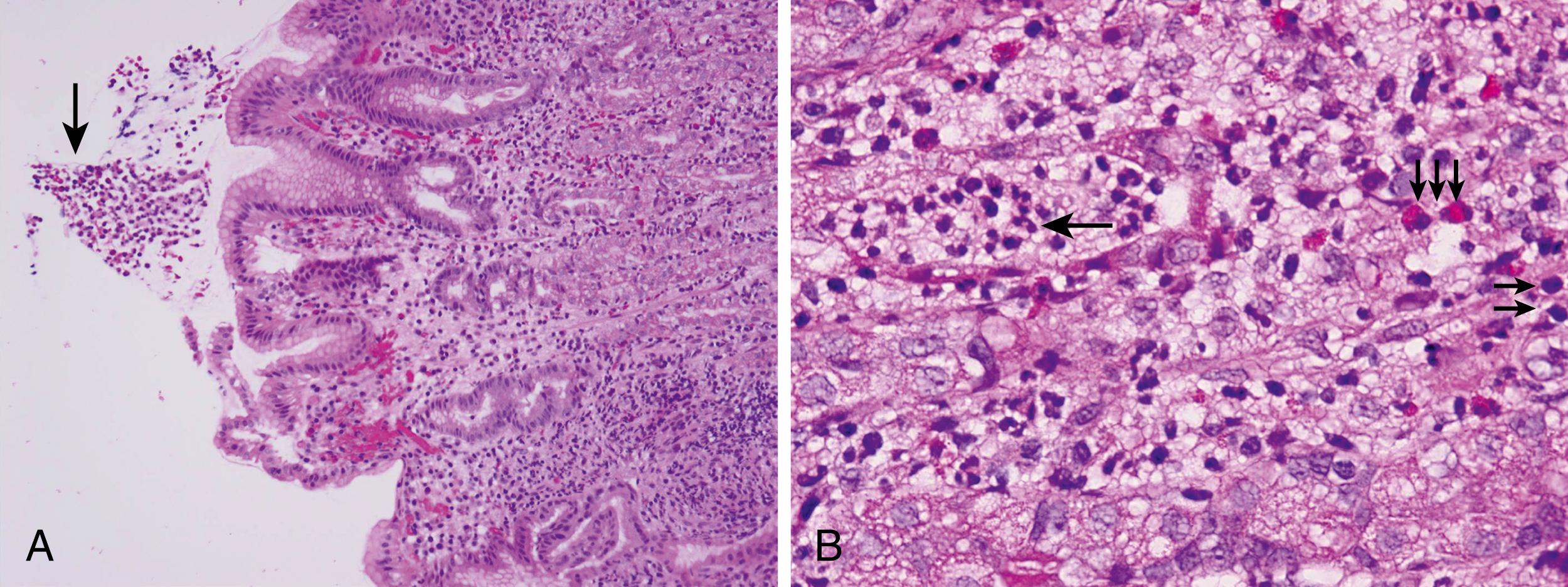 Fig. 26.3, Gastric Biopsy of a Child With non– Helicobacter pylori Gastritis.