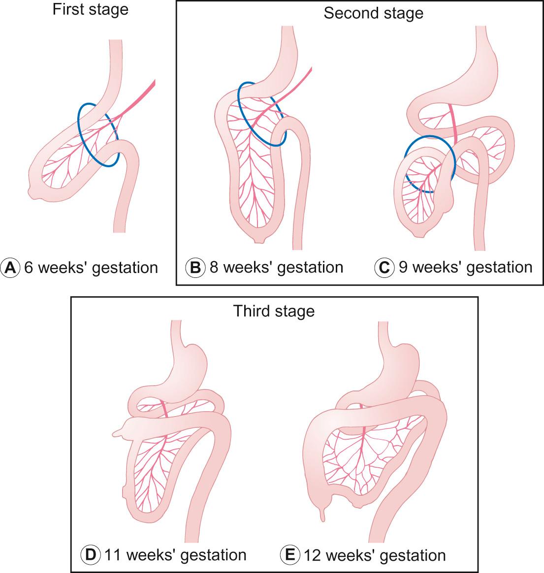 Fig. 14.2, Normal elongation and rotation of the midgut. This process is complex and can easily go wrong (see below). Failure of correct rotation leads to malrotation and failure of contents to return to the abdominal cavity results in exomphalos.