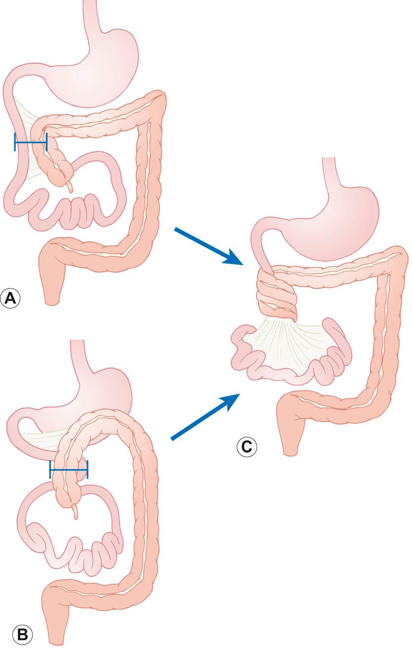 Fig. 14.4, Pathophysiology of midgut volvulus with malrotation. A narrow mesenteric attachment may cause midgut volvulus.