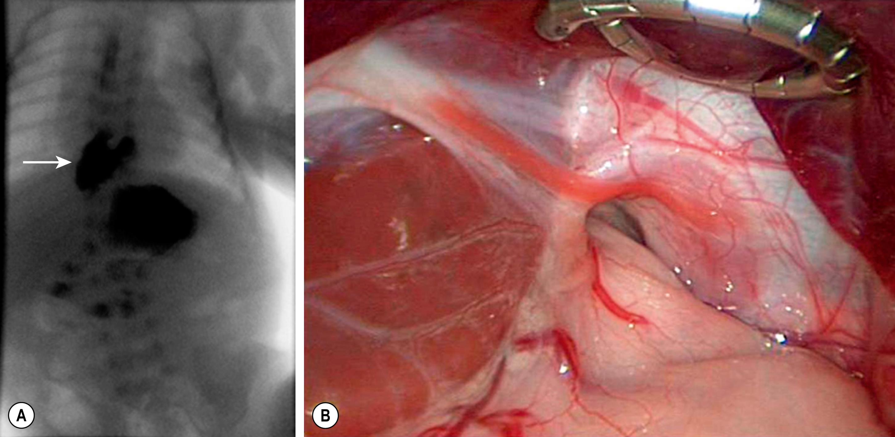 Fig. 28.1, The upper GI study (A) in this infant shows a portion of the stomach (arrow) herniated into the mediastinum. On the right (B) , the operative photograph shows the congenital hiatal hernia with a large hiatal defect and herniation of the stomach into the mediastinum.