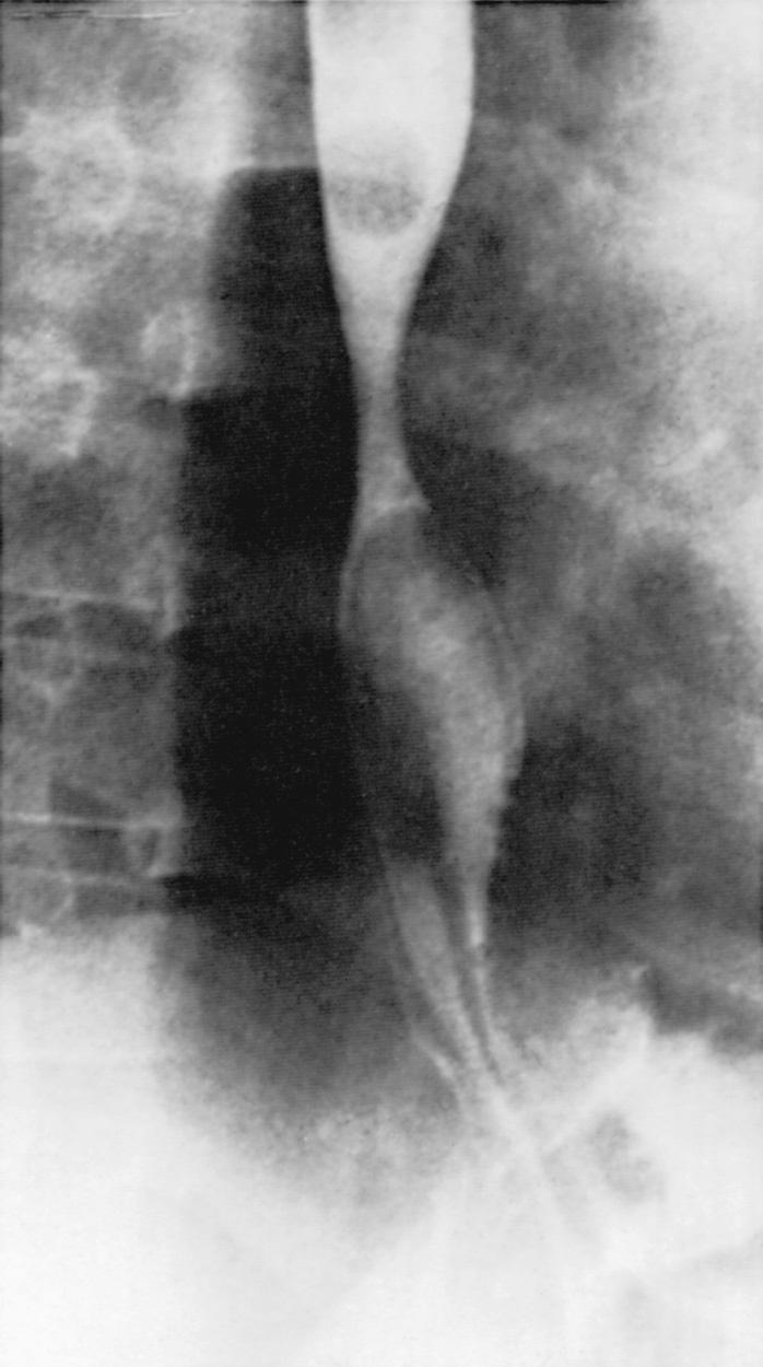 Fig. 349.1, Barium esophagogram demonstrating free gastroesophageal reflux.