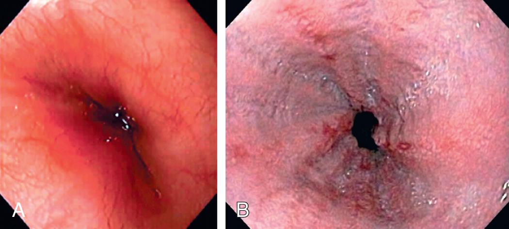 Fig. 349.2, Endoscopic image of a normal esophagus (A) and erosive peptic esophagitis (B) .