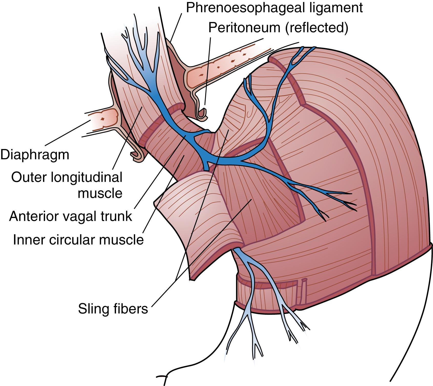 Fig. 43.1, Schematic drawing of the muscle layers at the gastroesophageal junction. The intrinsic muscle of the esophagus, diaphragm, and sling fibers contribute to lower esophageal sphincter pressure. The circular muscle fibers of the esophagus are at the same depth as the sling fibers of the cardia.