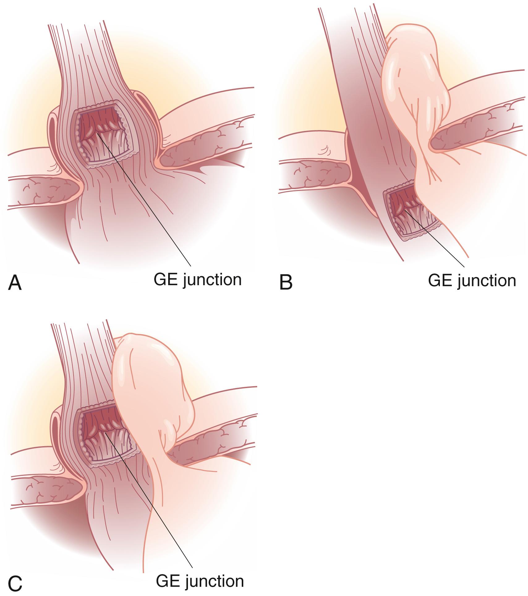 Fig. 43.2, The three types of hiatal hernia. (A) Type I is also called a sliding hernia. (B) Type II is known as a rolling hernia. (C) Type III is referred to as a mixed hernia. GE , Gastroesophageal.