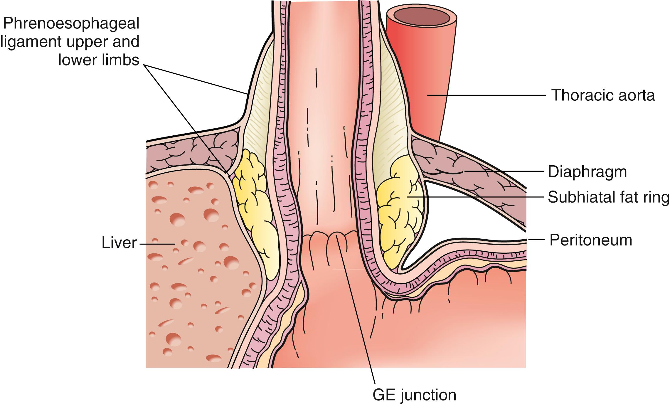 Fig. 43.3, Section of the gastroesophageal ( GE ) junction demonstrates the relationship of the peritoneum to the phrenoesophageal membrane. The phrenoesophageal membrane continues as a separate structure into the posterior mediastinum. The parietal peritoneum continues as the visceral peritoneum as it reflects onto the stomach.