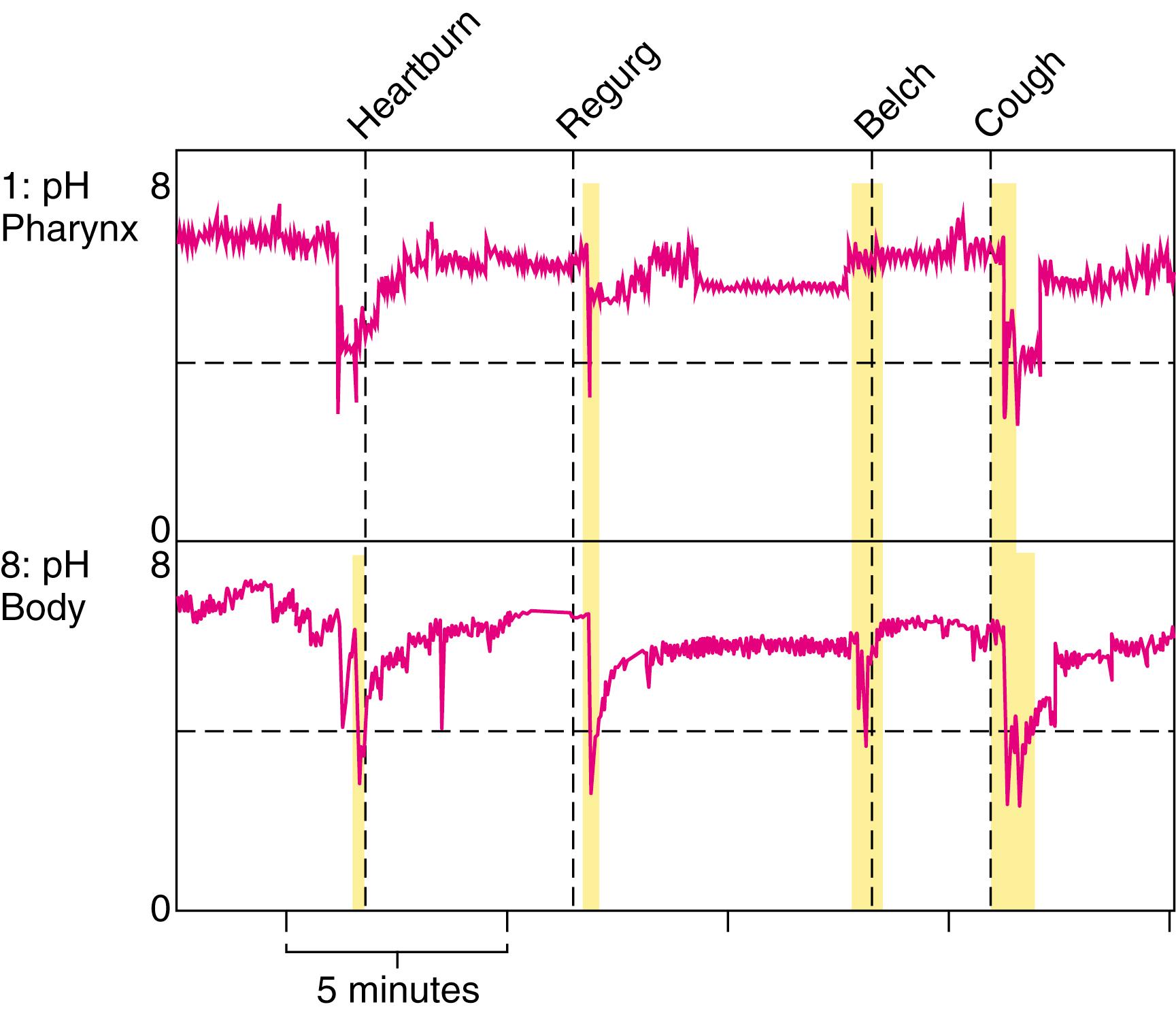 Fig. 43.4, A 1-hour segment from a 24-hour ambulatory pH study. Time is marked on the x-axis, and pH is marked on the y-axis. Symptom events are marked along the top of the tracing.