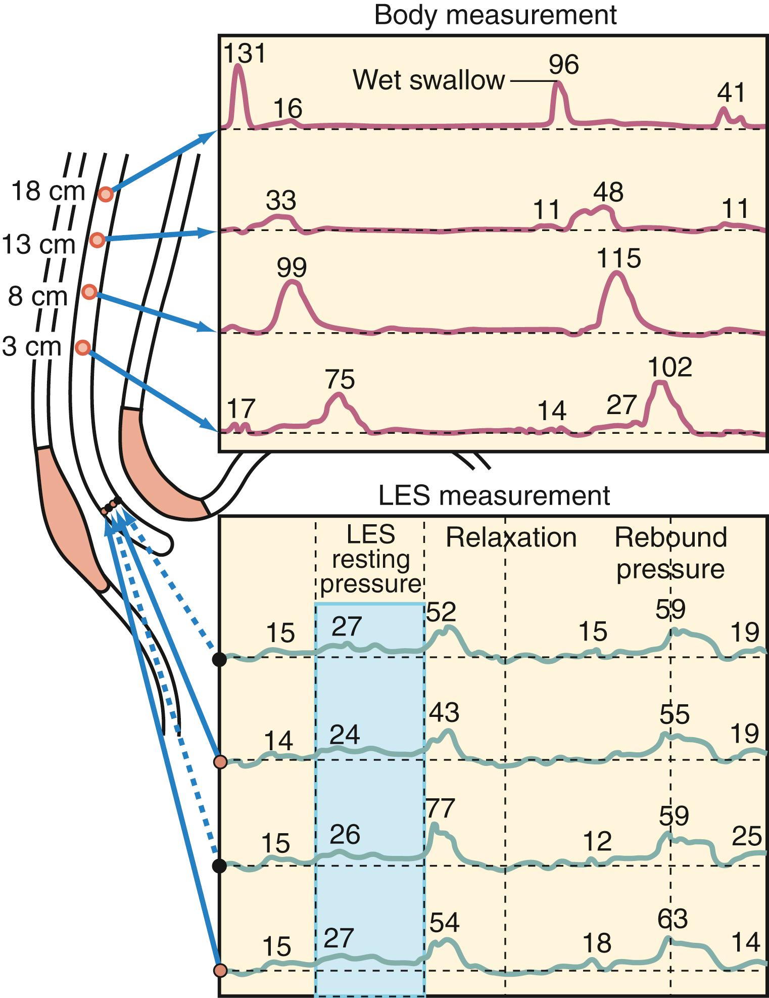 Fig. 43.5, Representative linear tracings from standard esophageal manometry. A wet swallow initiates both esophageal peristalsis and lower esophageal sphincter ( LES ) relaxation.