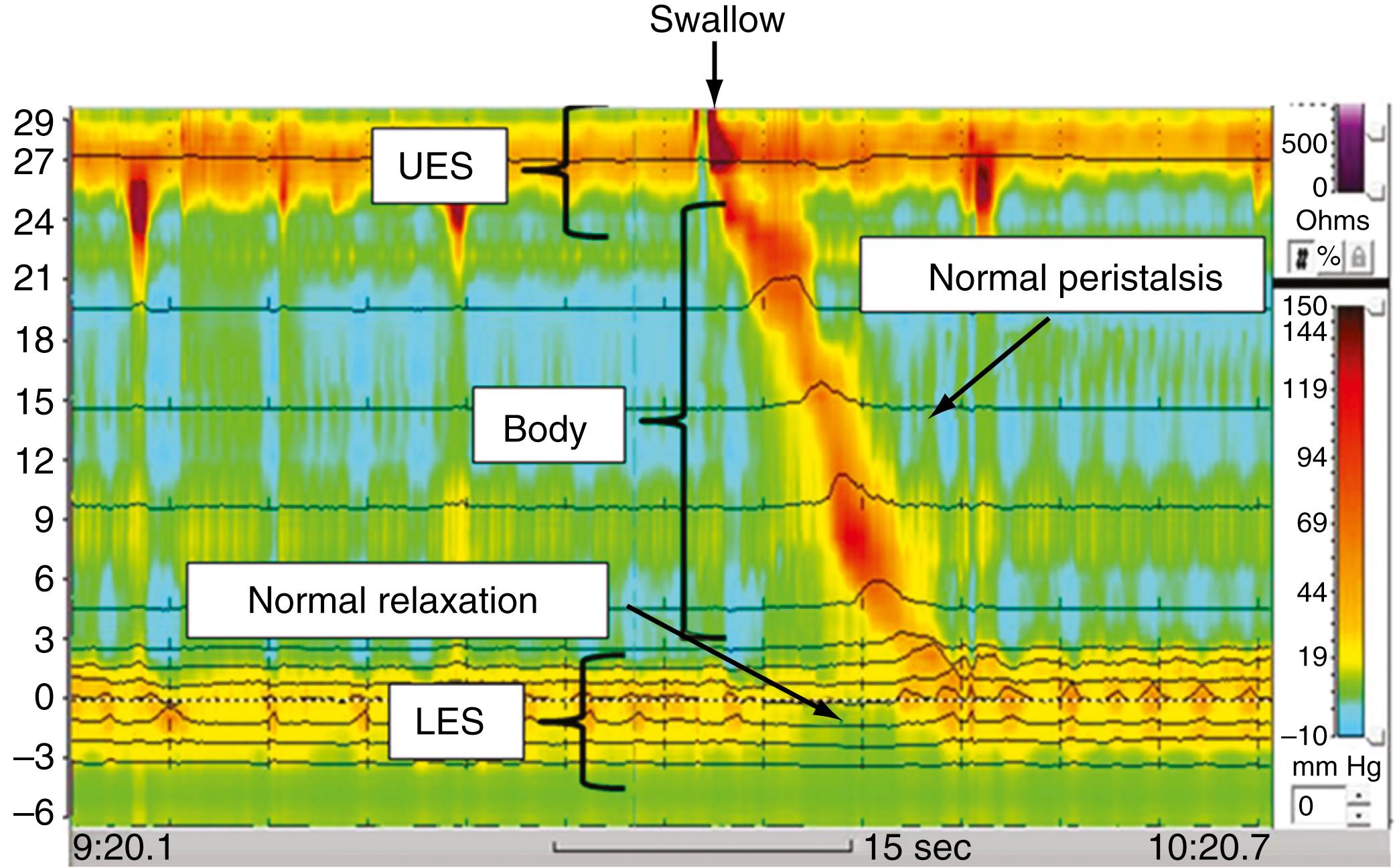 Fig. 43.6, High-resolution esophageal manometry. The initiation of a swallow is associated with simultaneous relaxation of the upper esophageal sphincter ( UES ) and lower esophageal sphincter ( LES ) and onset of peristalsis in the esophageal body.