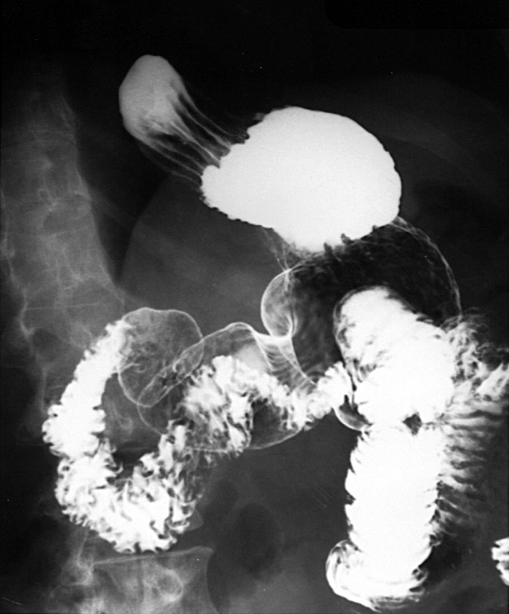 Fig. 43.7, Upper gastrointestinal series demonstrating a large hiatal hernia. The rugal folds of the stomach clearly transgress the shadow of the left hemidiaphragm.