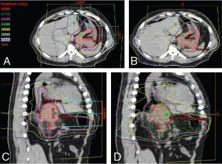 Fig. 10.1, Representative axial and sagittal slices for comparison intensity-modulated proton therapy (IMPT) (A and C) and intensity-modulated radiation therapy (IMRT) (B and D) plans for a patient with an 8-cm T3N1 gastric adenocarcinoma with extension into the esophagus. Target coverage was similar between the two plans, but the mean heart dose was 17.5 GyE in the IMPT plan compared with 22.2 Gy in the IMRT plan, and the mean liver dose was 9.4 GyE in the IMPT plan compared with 19.8 Gy in the IMRT plan.