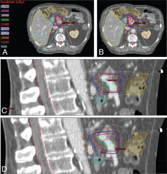 Fig. 10.2, Representative axial and sagittal slices for comparison intensity-modulated proton therapy (IMPT) (A and C) and intensity-modulated radiation therapy (B and D) plans for a patient with borderline resectable pancreatic adenocarcinoma treated with stereotactic radiation therapy to a total dose of 33 Gy (or Gy [relative biological effectiveness]) in 5 fractions. The maximum dose to the duodenum was similar, but the volume of bowel receiving lower doses (5, 10, and 15 Gy) was significantly lower with IMPT.
