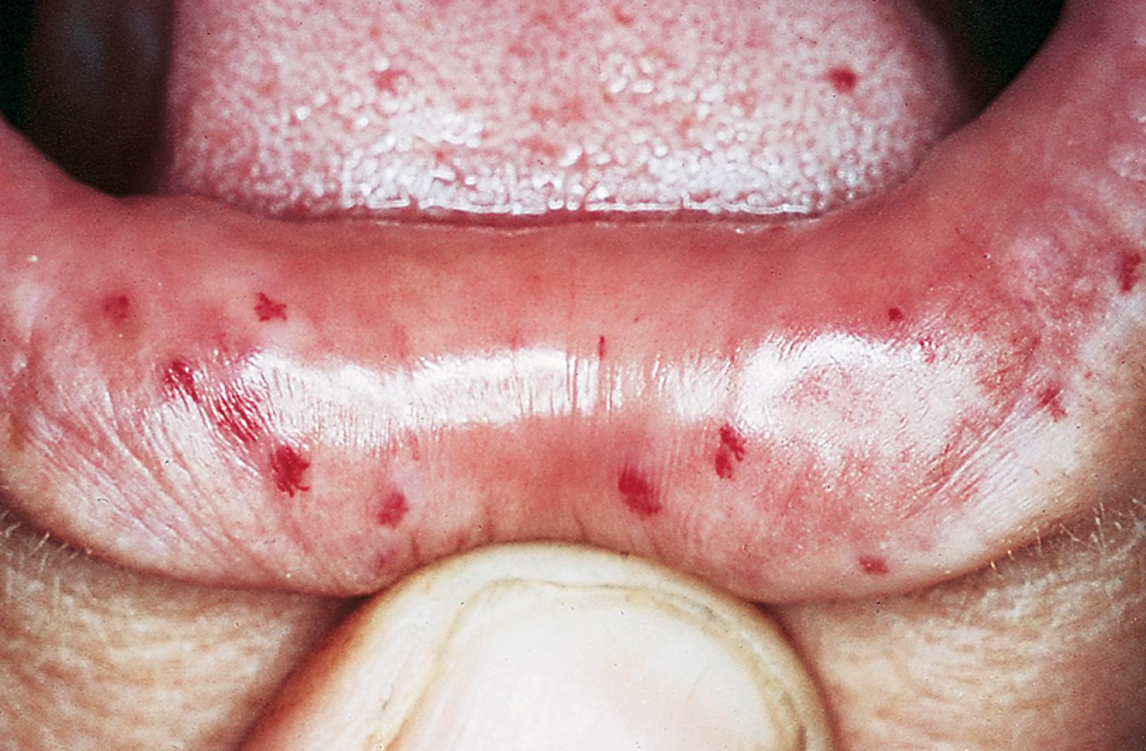 Fig. 16.3, Hereditary hemorrhagic telangiectasia. Telangiectasias are found on the lips, oral mucosa, nasal mucosa, skin, and conjunctiva. Epistaxis is the most common manifestation of the disease. Blood transfusions may be required.