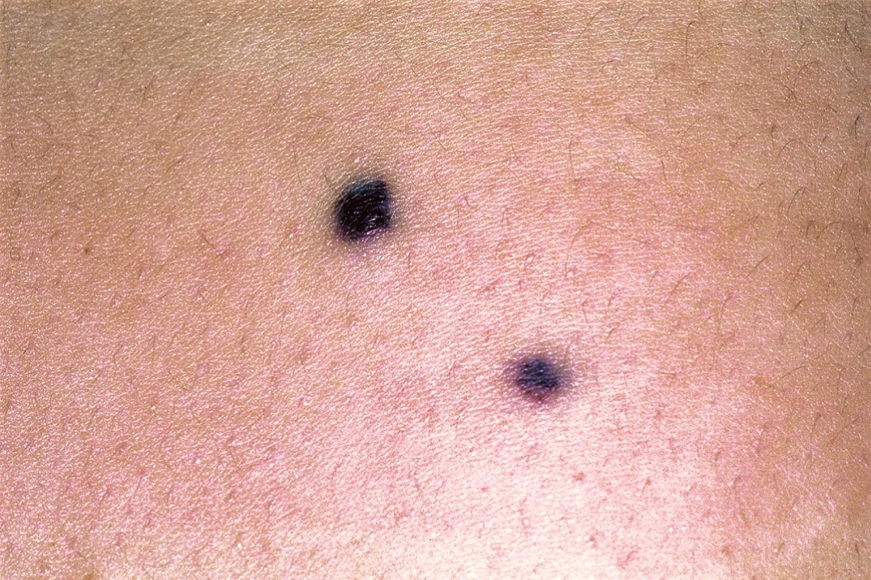 Fig. 16.4, Blue rubber bleb nevus syndrome. A 16-year-old girl was evaluated for multiple 3 mm–1 cm blue nodules on the skin. She had a history of similar lesions in the gastrointestinal tract, which were discovered during surgery for small bowel obstruction from intussusception.