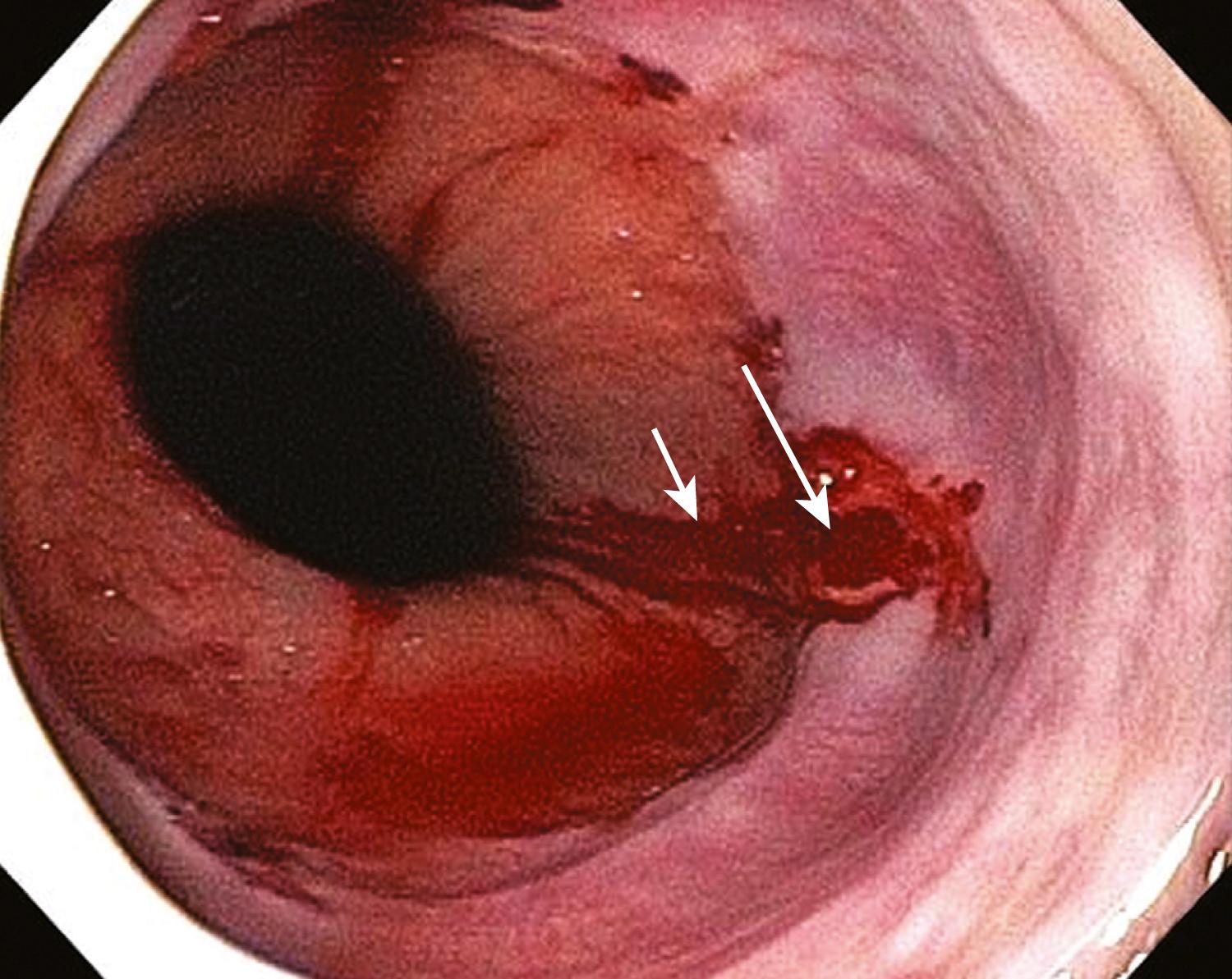 Fig. 16.5, Endoscopic appearance of a Mallory-Weiss tear with mild oozing. Note that the tear starts at the gastroesophageal junction (long arrow) and extends distally into the hiatal hernia (short arrow) .