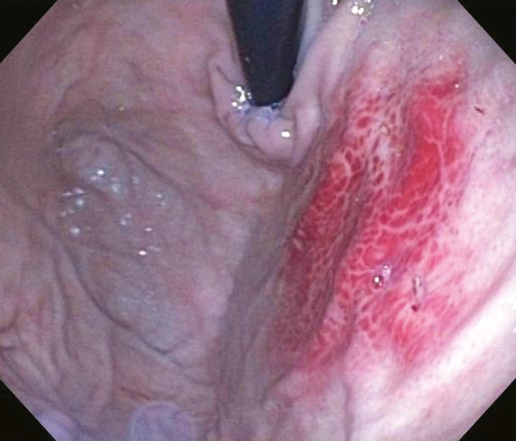 Fig. 16.6, Endoscopic view of fundus showing area of prolapse gastropathy.